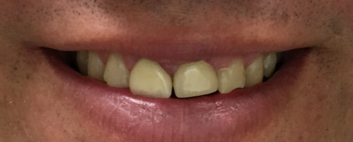 dental crowns allen tx