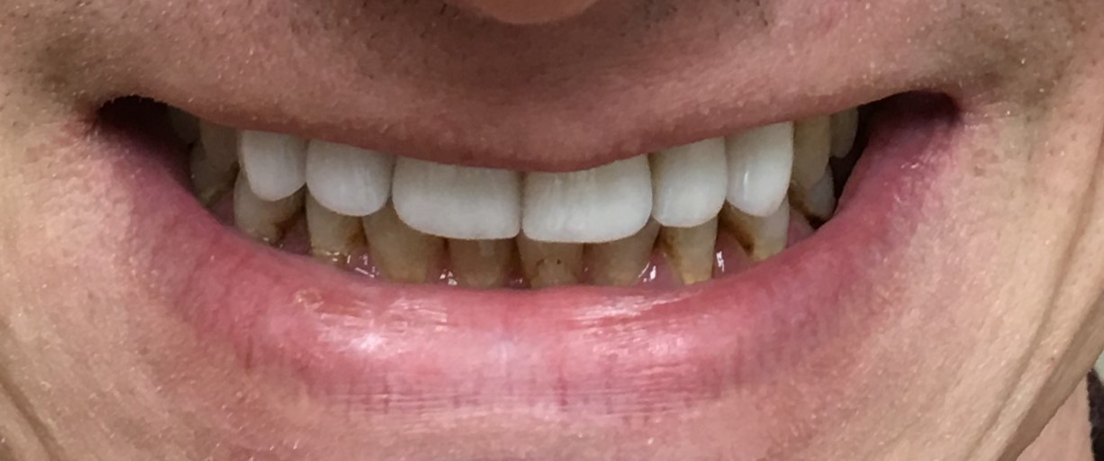 allen tx smile makeover