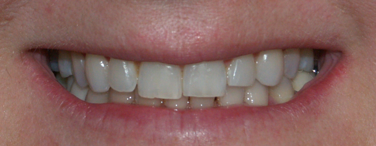 veneers in allen tx