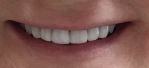 allen tx dental veneers