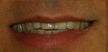 allen tx dental bridges