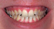 teeth whitening in allen tx