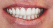 allen tx teeth whitening